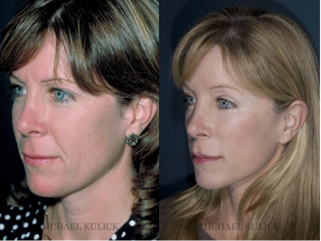 Facelift Before and After Image