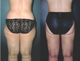 Liposuction Before and After Image