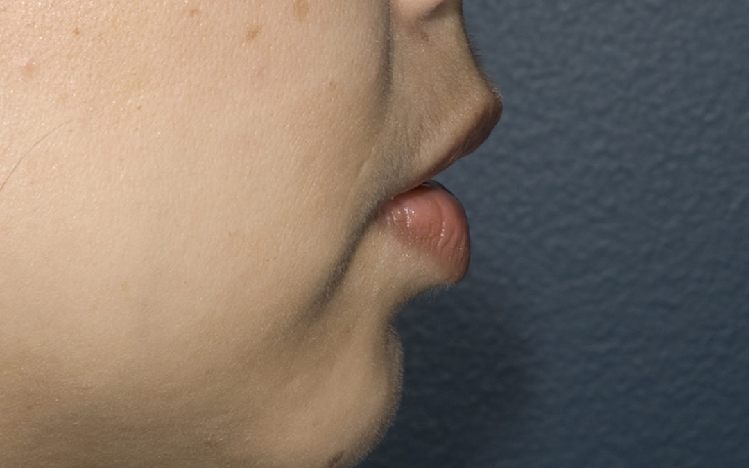 What’s the Buzz About Chin Augmentation?