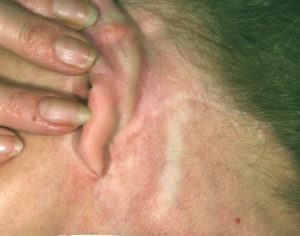 hypopigmented skin neck scar that could be fixed with ReLume