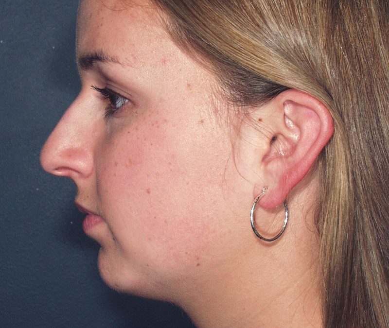 Combining a Chin Augmentation and a Rhinoplasty