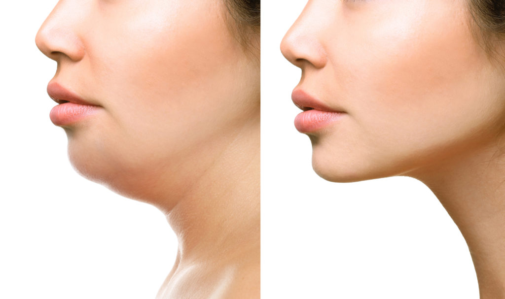 Chin Augmentation Procedure