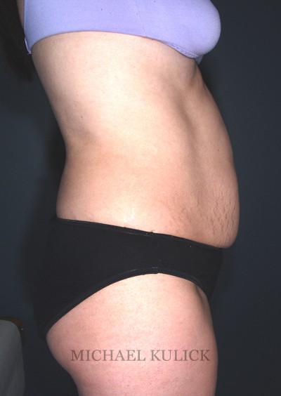 before results of tummy tuck after pregnancy