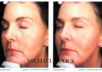 IPL-bef-and-after-brown-spots-copy