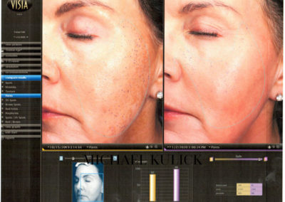 IPL-pores-before-and-after-copy-scaled