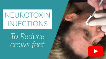 Neurotoxin injections to reduce crows feet