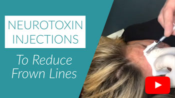 Neurotoxin injections to reduce frown lines