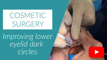 Cosmetic surgery Improving lower eyelid dark circles