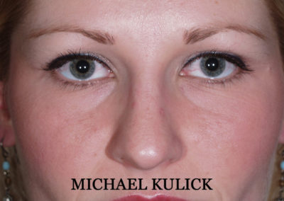 Rhinoplasty #2021 Before Front Profile Dr. Michael Kulick, MD