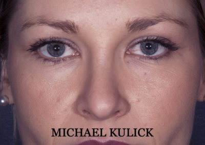 Rhinoplasty Case Study 2021 Front Profile Dr. Michael Kulick, MD